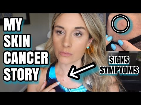 MY SKIN CANCER STORY - MY SIGNS AND SYMPTOMS!