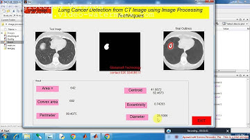 Lung Cancer Detection from CT Image using Image Processing Techniques new