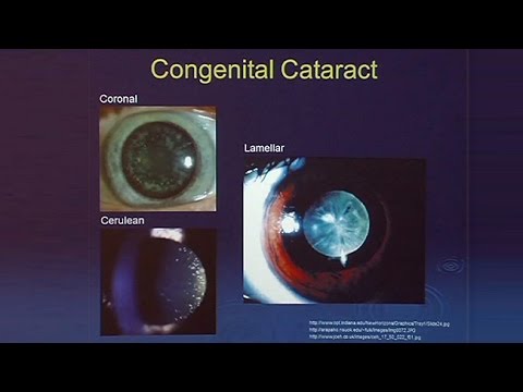 Video: Dekt Medicare Alle Kosten Van Cataractchirurgie?