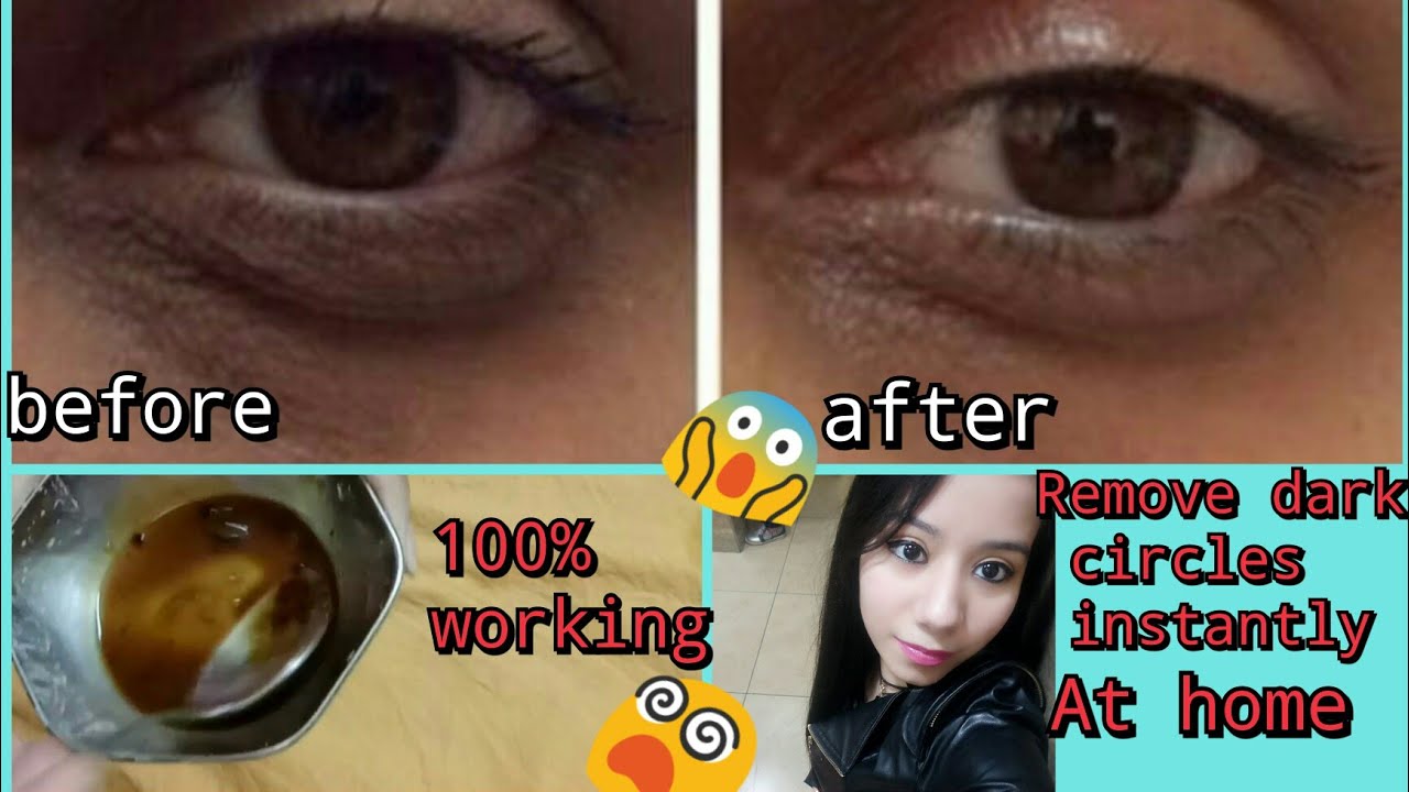 Remove dark circles in 7 days!! 😱😱 Naturally at home!! YouTube