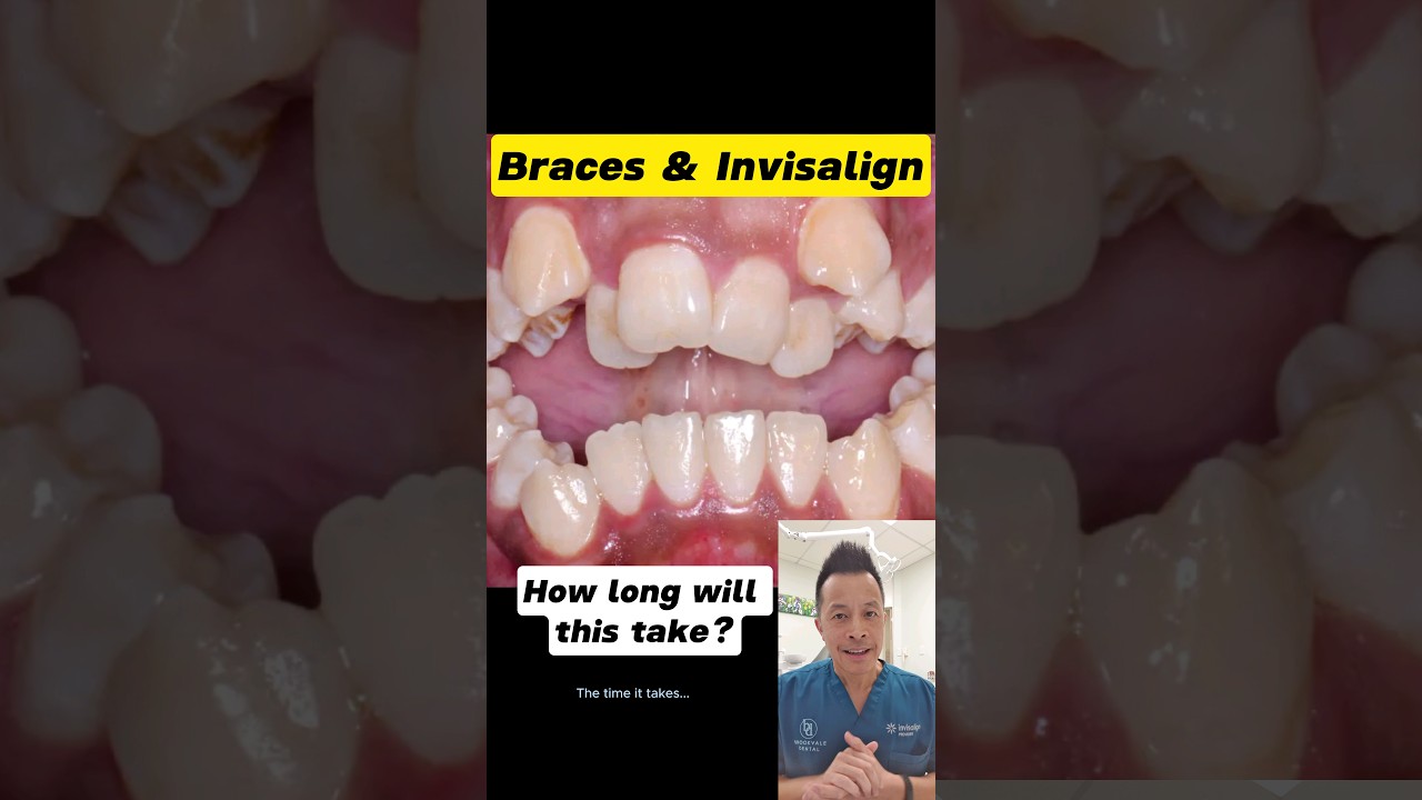 Braces & Invisalign: How Many Months Until Straight Teeth? 