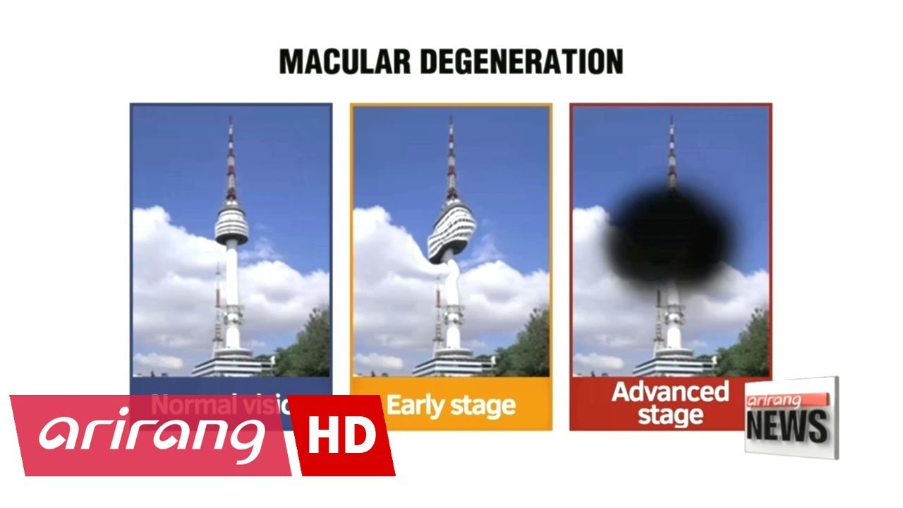 Korean traditional foods prove effective in alleviating macular degeneration, prevent \\