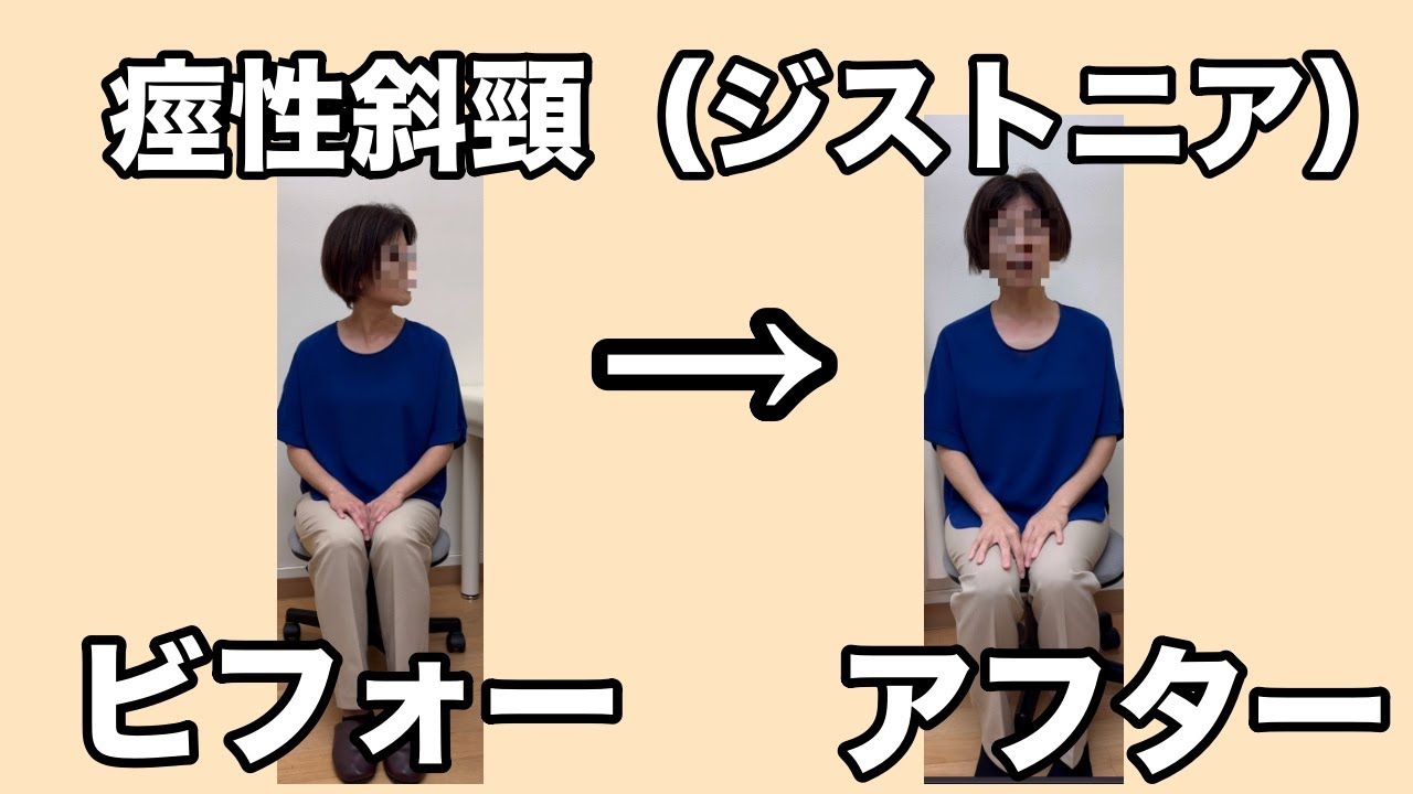 痙性斜頸（ジストニア）と診断された女性の初回施術ビフォーアフター動画