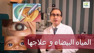 المياه البيضاء , أسبابها , طرق العلاج , و ما هى قطرة الحماية من و علاج المياه البيضاء؟