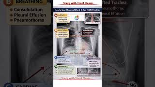 Chest X-Ray A-B-C-D-E #Rule 😱 30 Sec Me CXR Read Karna Seekho!