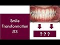Smile Transformation #3 | Dr. Jiten Vadukul | The Orthodontist