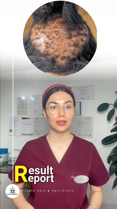 PRF CCCA Alopecia, and Traction Alopecia Treatment!