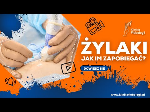 Wideo: Zapobieganie żylakom