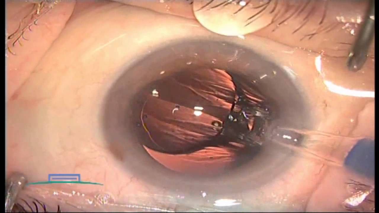 Operación de cataratas. Hospital de La Ribera. - YouTube