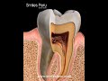 Vertical dental root crack at the tip/ Fisura dental vertical en la raíz del diente