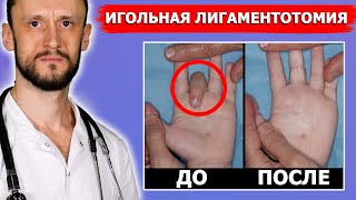 Болезнь Нотта (щелкающий палец) и контрактура Дюпюитрена | ЛЕЧЕНИЕ | 100% результат без шрамов