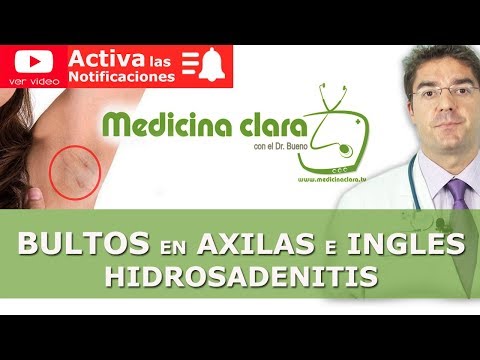 Vídeo: Hervir Bajo El Brazo: Causas Y Síntomas De Forúnculos En Las Axilas