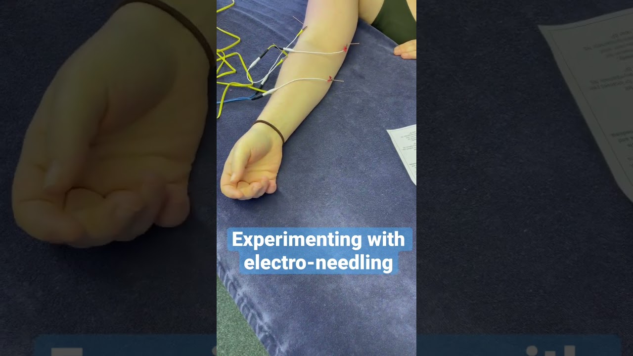 Electro Dry Needling – EP Bodywork Therapy