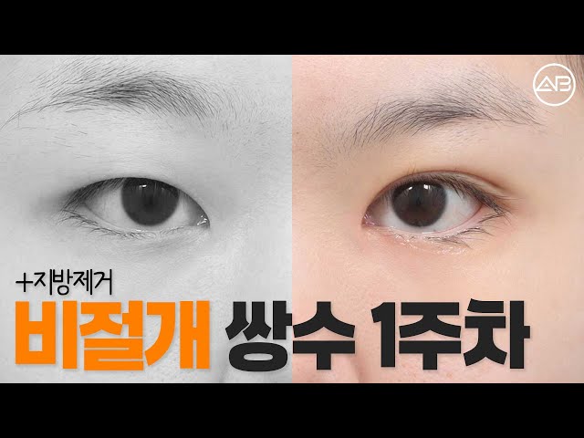무쌍에서 자연스러운 쌍꺼풀 얻기 | 후기있음 | 에이비성형외과