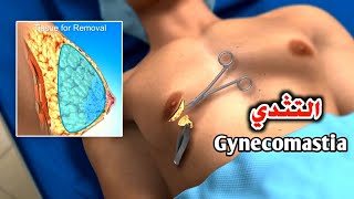 شاهد كيف تتم عملية ازالة التثدي لدي الرجال_Gynecomastia