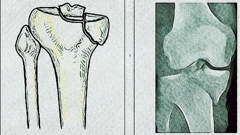 Posteromedial  Approach  to  the Proximal Tibia