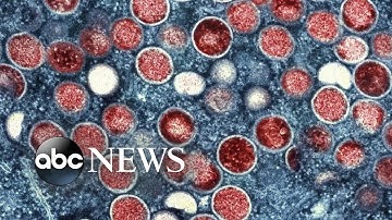 CDC issues new guidance as monkeypox cases reaches over 7,500 in US