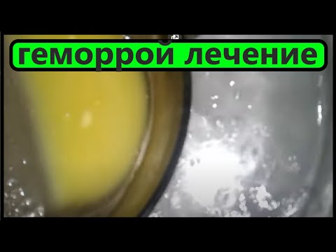 ЛЕЧЕНИЕ ГЕМОРРОЯ  - ПОТРЯСАЮЩИЙ ЭФФЕКТ.