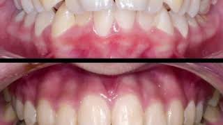 ارتودنسی ثابت دو فک بدون کشیدن دندان | کلینیک تخصصی دندانپزشکی کانسپتا