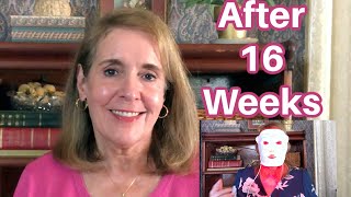 Results after 16 Weeks using Omnilux Contour Mask On Mature Skin 65+