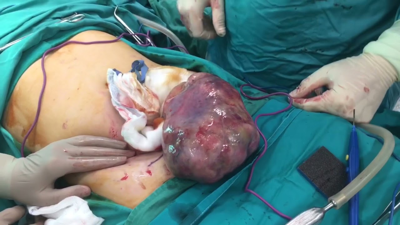 Borderline tumor of the ovary