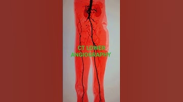 Thumbnail of CT ANGIOGRAPHY #ct  #music #song #subscribe  #medicalstdents #like  #skeleton #medicals