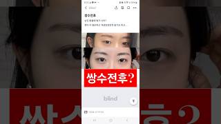 (실제사연) 쌍수전후? 병원 어디냐고? #쌍수후기 #쌍커풀수술 #쌍수전후