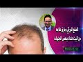 الصلع الوراثي وطرق علاجه من البيت عندك ببعض الجنيهات - الدكتور أحمد أبو النصر