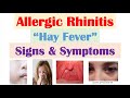 Allergic Rhinitis (Hay Fever & Seasonal Allergies) Signs & Symptoms (& Why They Occur)