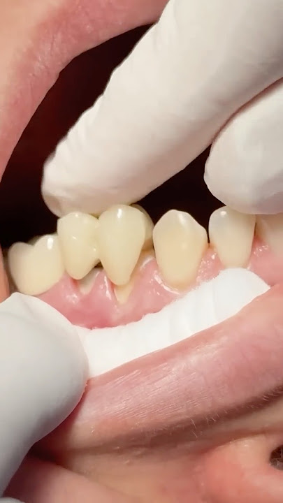 Zirconia crowns for root canal treated teeth #dentist