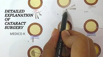 CATARACT SURGERY LECTURE | SICS IN DETAIL | OPHTHALMOLOGY LECTURES |