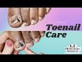 👣Toenail Fungus Care at Home👣