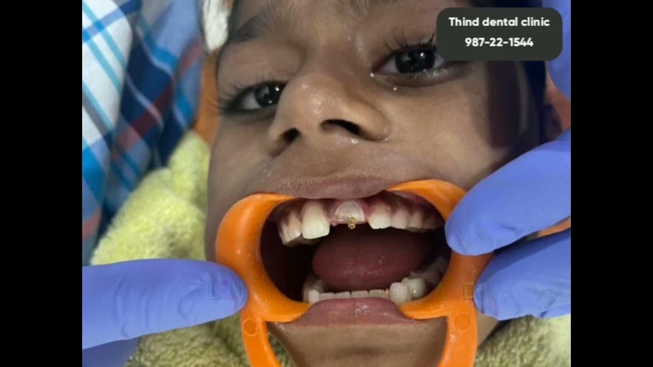 Fractured tooth build up by Dr Rajanbir Thind Thind Dental Clinic
