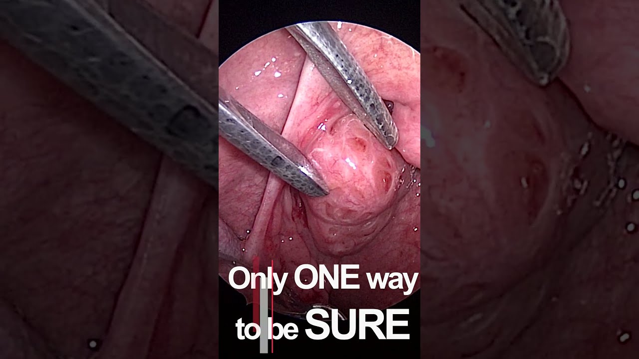 Squeezing Infected Tonsils