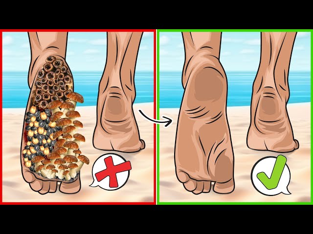 ASMR Remove Ticks & Maggot Infected From Leg | Severely Injured Treatment Animation class=