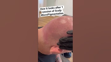 After 1 of 3 Session of Scalp MicroPigmentation #shorts #scalpmicropigmentation #smpaustralia #smp