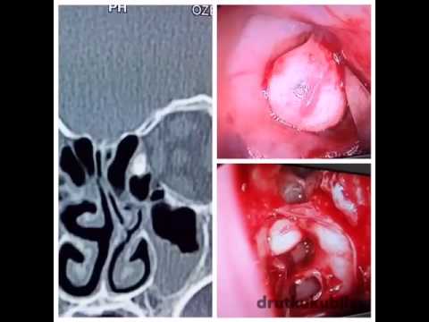 Video: Was ist die Behandlung für Osteom?