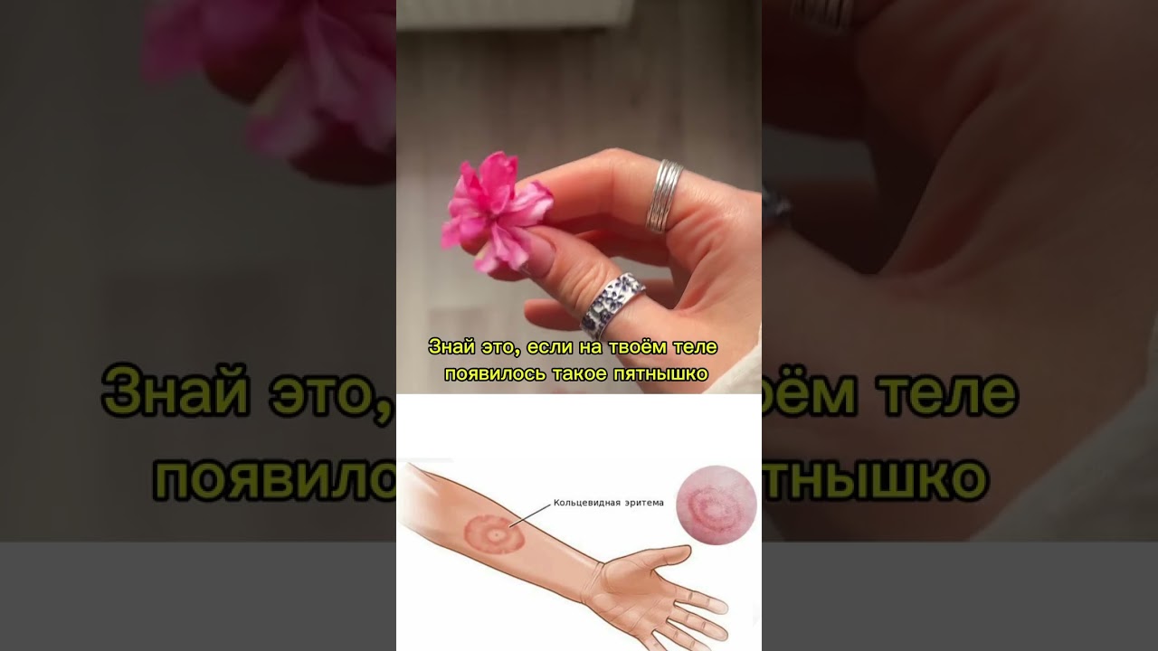 ⚠️Что делать при появлении эритемы?⠀