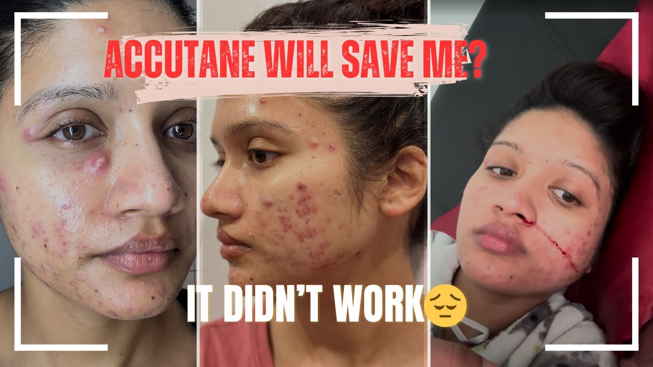 Still Fighting Acne After Accutane | My 2025 Acne Journey - YouTube