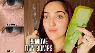 HOW TO REMOVE TINY BUMPS ON YOUR FACE! *They're NOT Acne! | MILIA