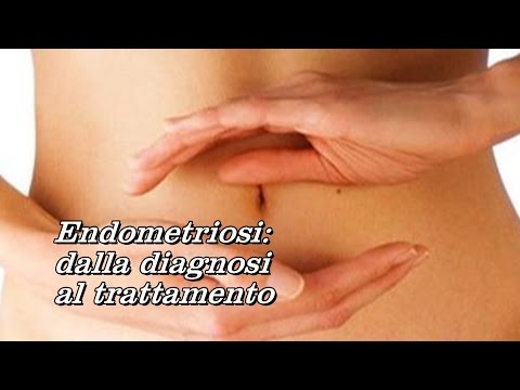 Video: Endometriosi: Dolore Alle Gambe: Identificazione, Trattamento E Altro