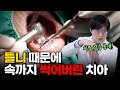 틀니 때문에 속까지 썩어버린 치아, 어떻게 치료할까?ㅣ산본 미래플란트치과