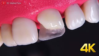 AMAZING fractured tooth restoration in 4k