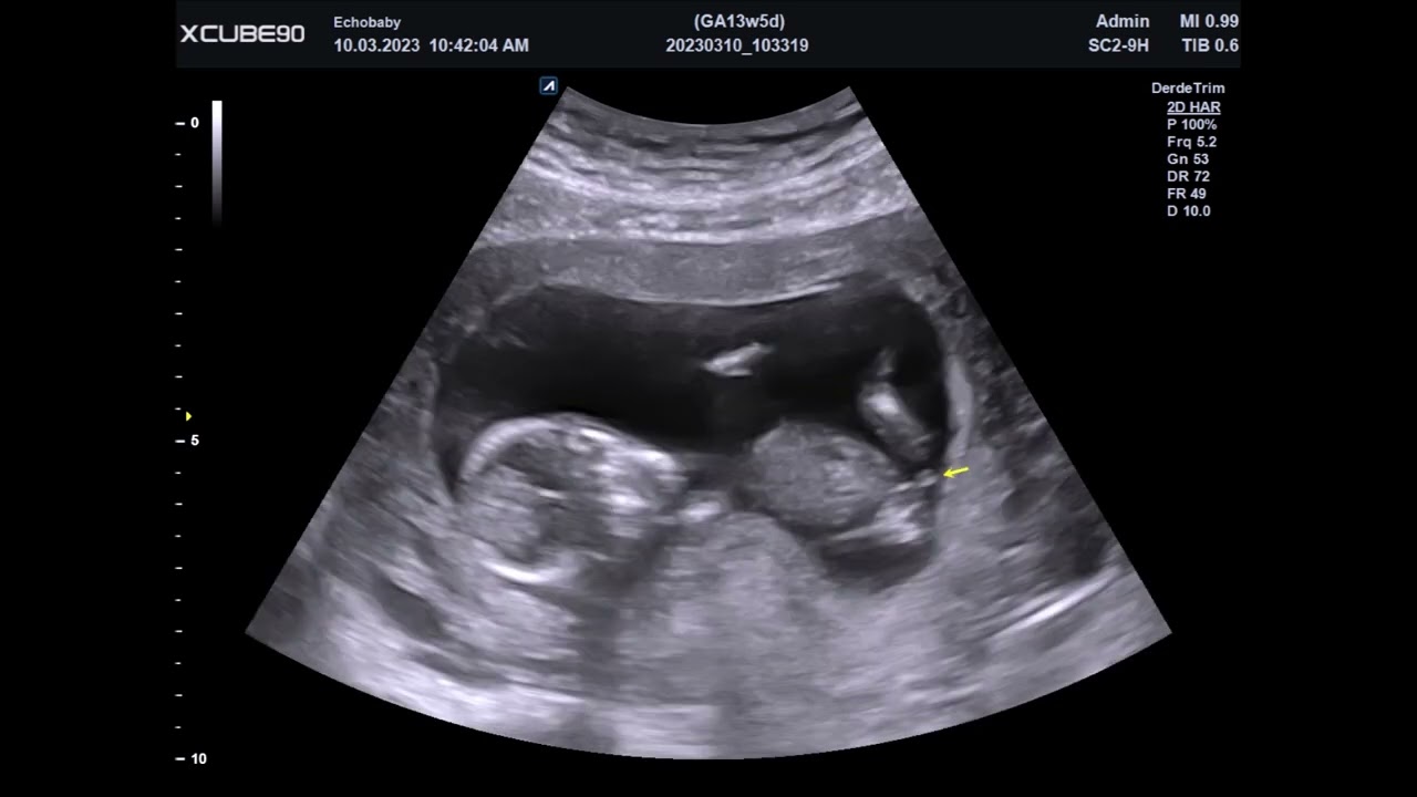 Echo 13 Weken Geslachtsbepaling, Foto's Meisjes