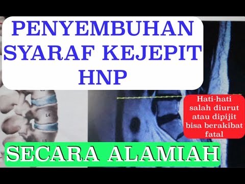 PENYEMBUHAN SYARAF KEJEPIT / HNP SECARA ALAMIAH