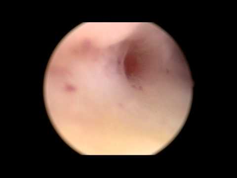 Fibroid, Uterus Retroverted, Uterus Ventrosuspension, Infertility Painful Sex,_002.mpg
