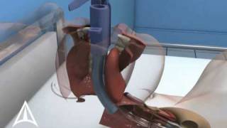 Intubix Endotracheal Tube Holder - 3D Medical Device Animation