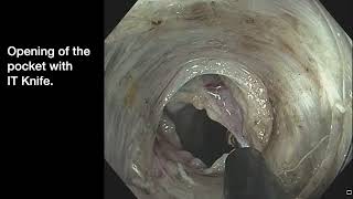 ESD in the right colon: clip and band, retroflexion, undersaline immersion.