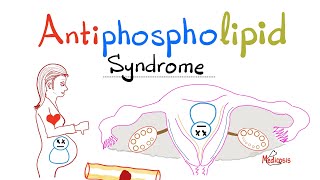 Details Antiphospholipid Antibody Syndrome (APS) - Thrombophilia - Hypercoagulability, Pregnancy, Migraine  Update