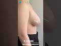 How Is Breast Asymmetry Corrected? Before &amp; After Results!